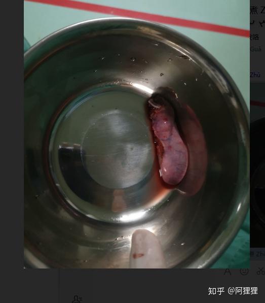 切除胆囊是一种怎样的感受?你后悔过吗? - 知乎