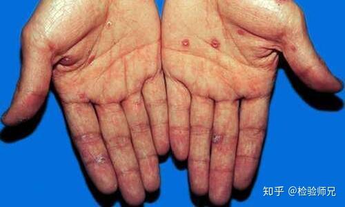 梅毒二期手部症状图片图片