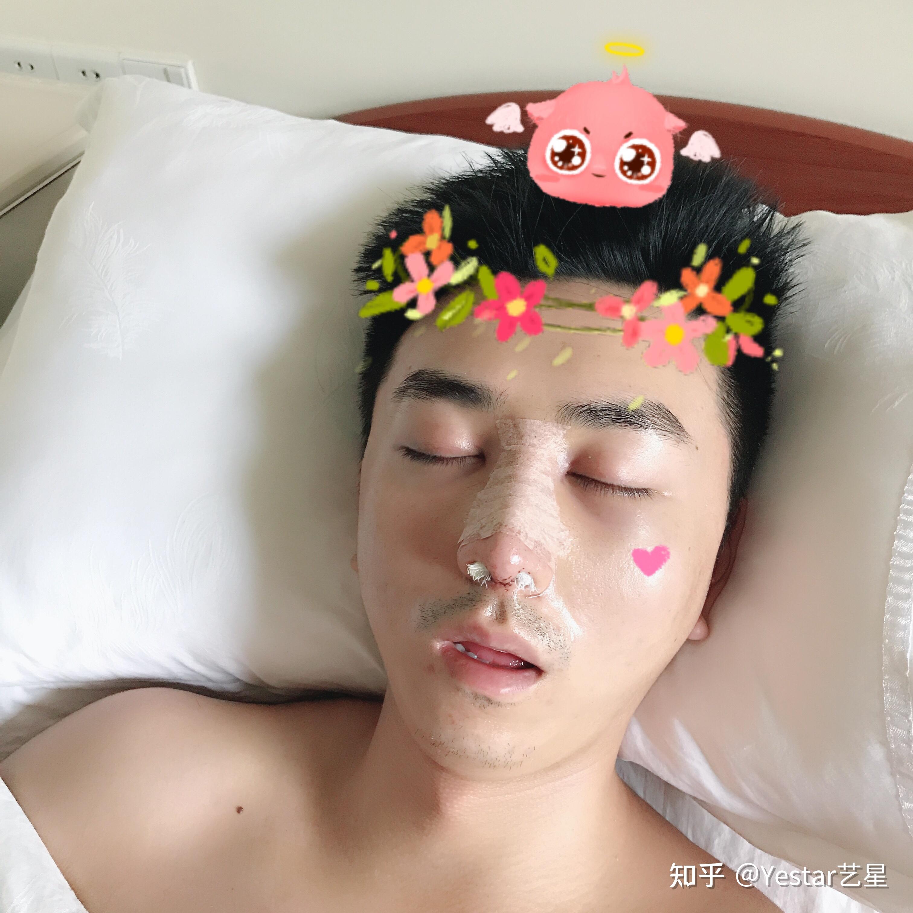 男生做鼻综合是什么体验? - 知乎