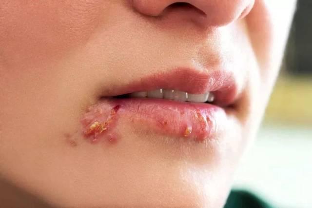 嘴角反复起水泡,又痒又疼怎么办?皮肤科医生教你一招