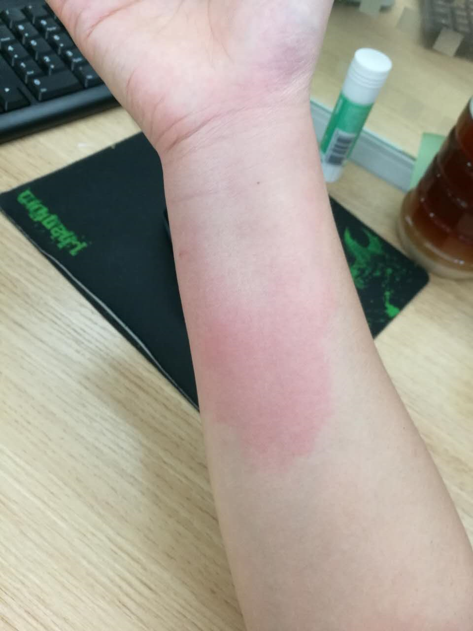 被红火蚁咬了怎么办又痒又痛的还肿了