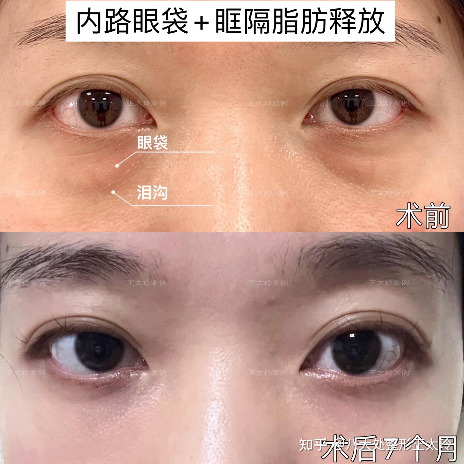 祛眼袋可以做眶隔脂肪释放术吗？ - 知乎
