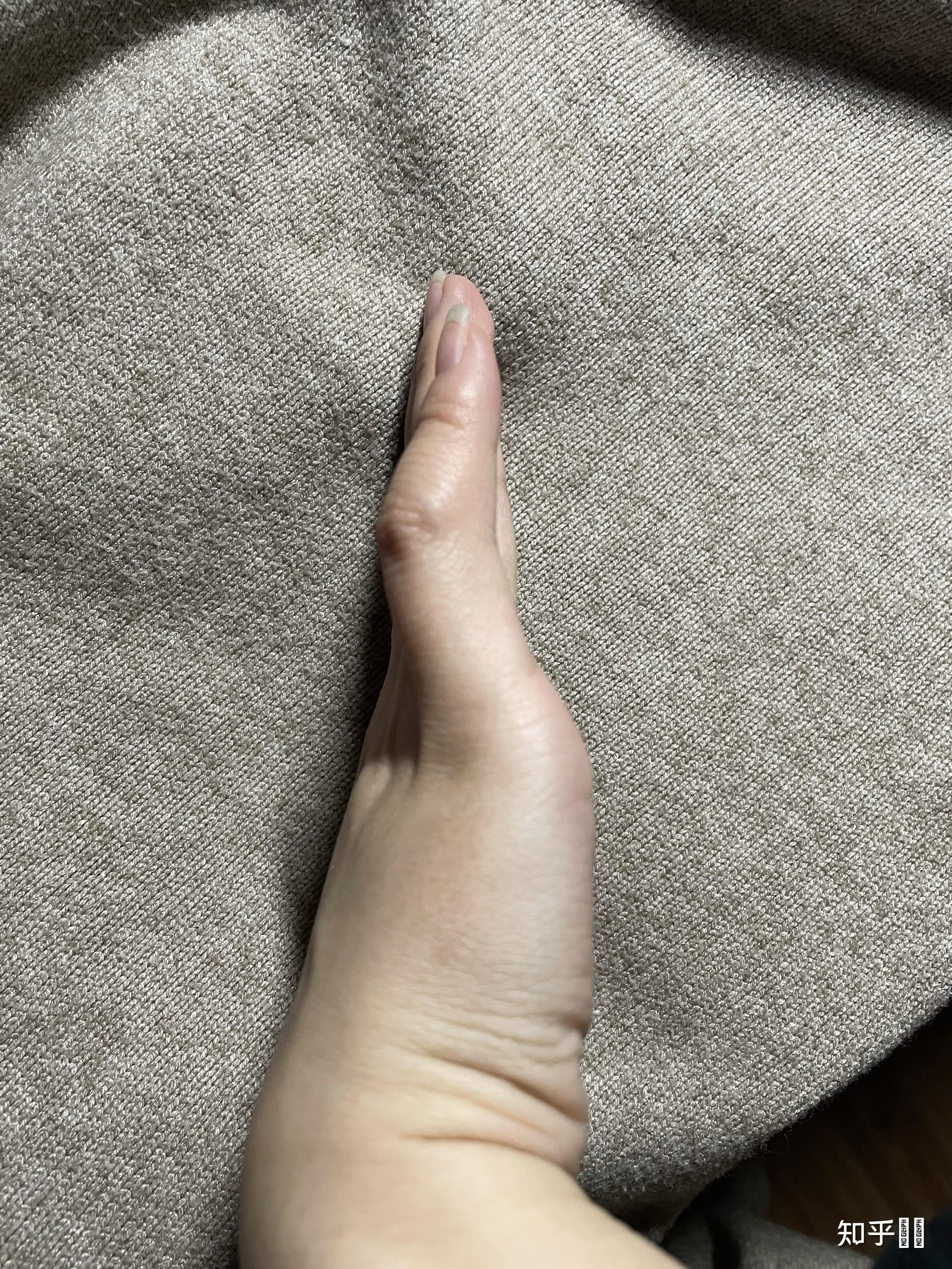 小拇指老是伸不直,张开手掌很明显可以看出!这是为什么?