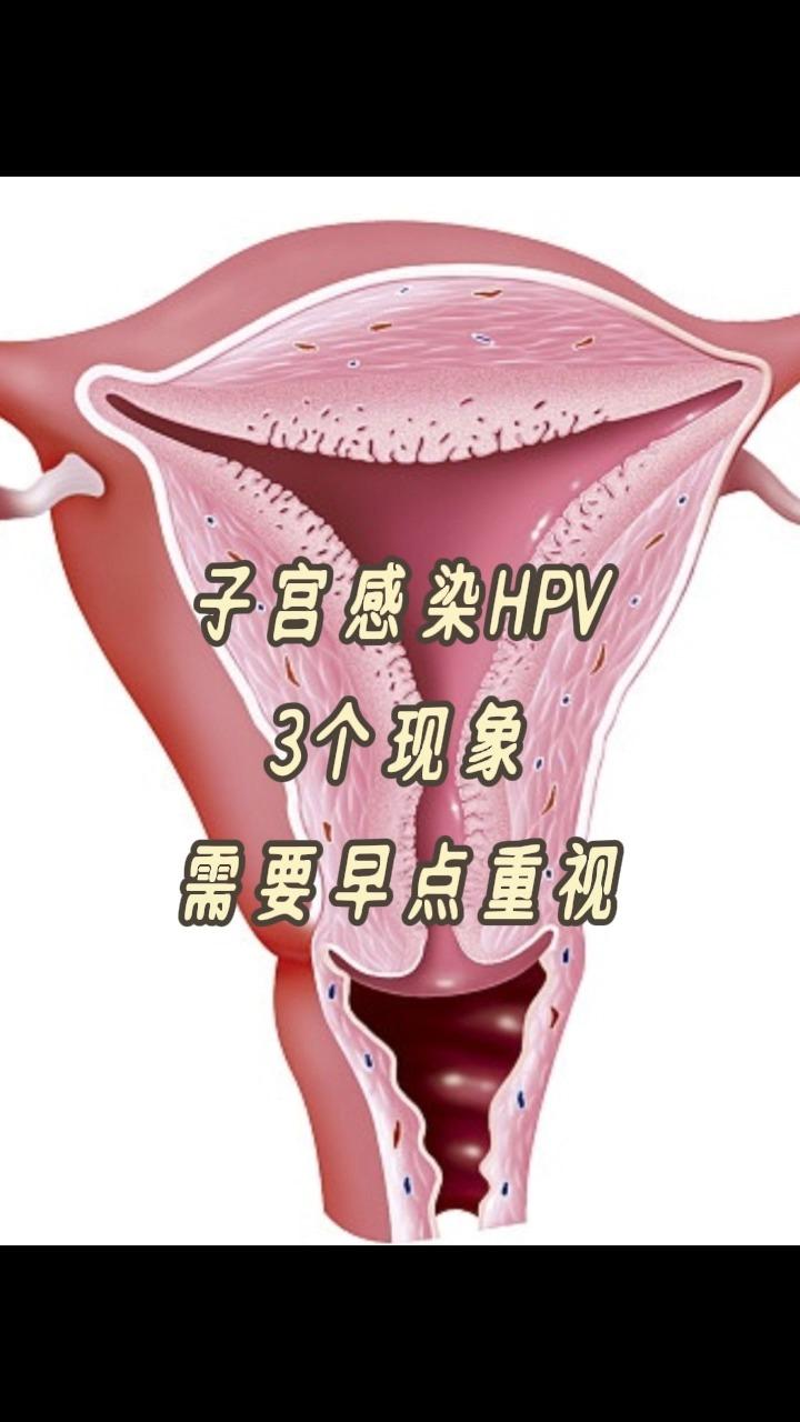 子宫感染hpv3个现象早点重视