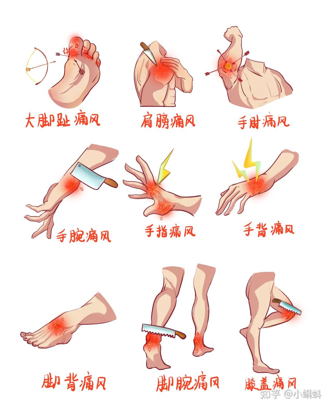 痛风前期有什么症状吗？ 知乎 1267