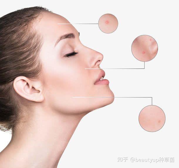 怎样才能不长闭口痘痘 v2-7da1c698f079be46401e1d0462ec8204_r.jpg