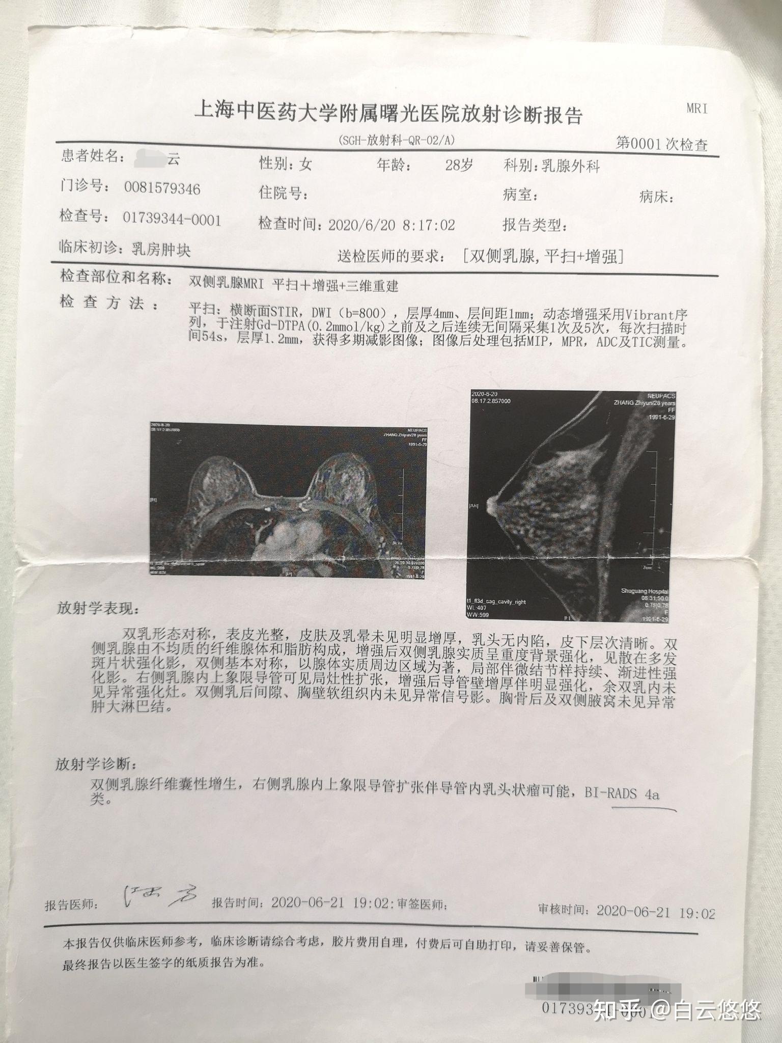 鄞州第二医院 动态新闻 花季少女一侧乳房疯长，原来是长了巨瘤！