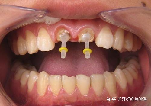 牙橋價格要多少 會很難清潔嗎 一篇為你完整解答
