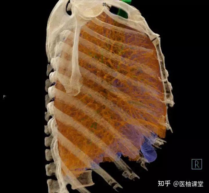 非常详细的肺部影像解剖 - 知乎
