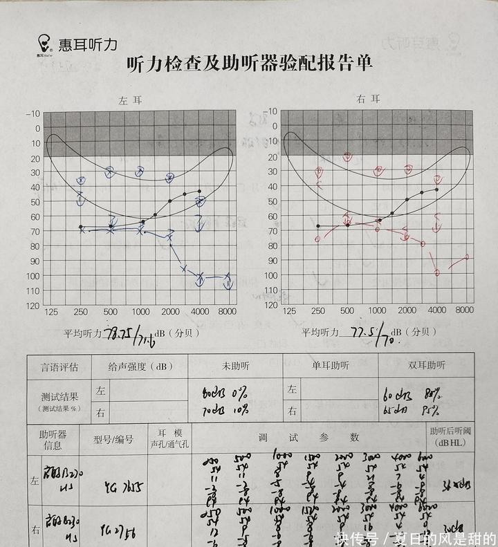 永川惠耳听力分享：言语分辨率较差的验配助听器案例 - 知乎