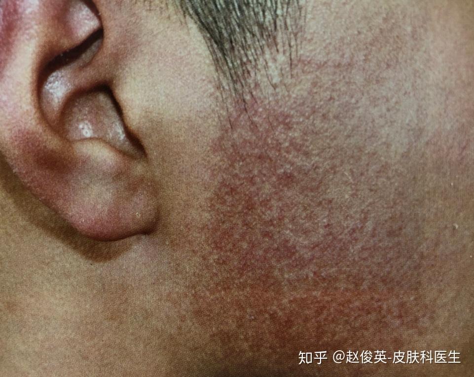 汗蒸对鸡皮肤有什么帮助(汗蒸对鸡皮肤有什么帮助吗)