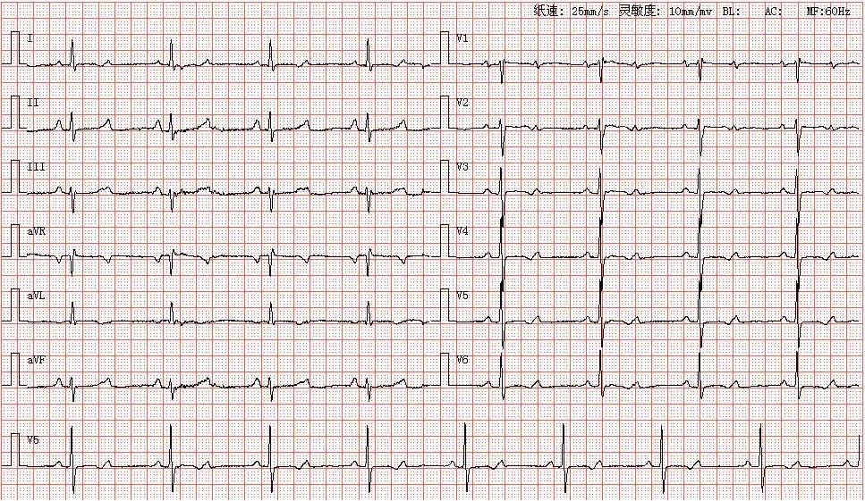 心电图图库丨二度ii型21房室传导阻滞系列