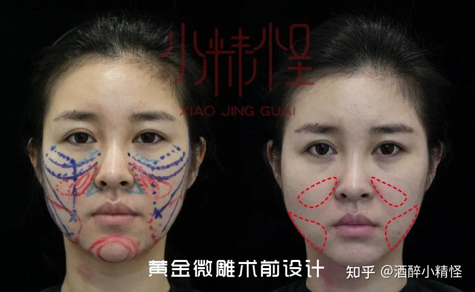 因此我们单独提取黄金微雕的吸脂设计区域苹果肌下缘(吸脂 紧致)