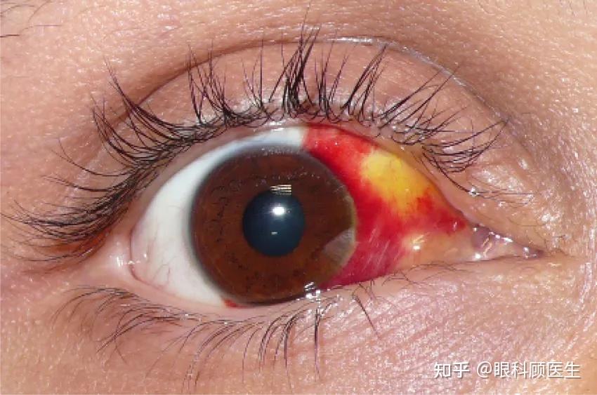 有一种眼红是真的红但真的不要怕