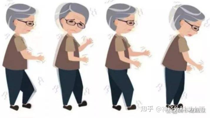 脑深部电刺激(DBS)治疗晚期帕金森病 - 知乎
