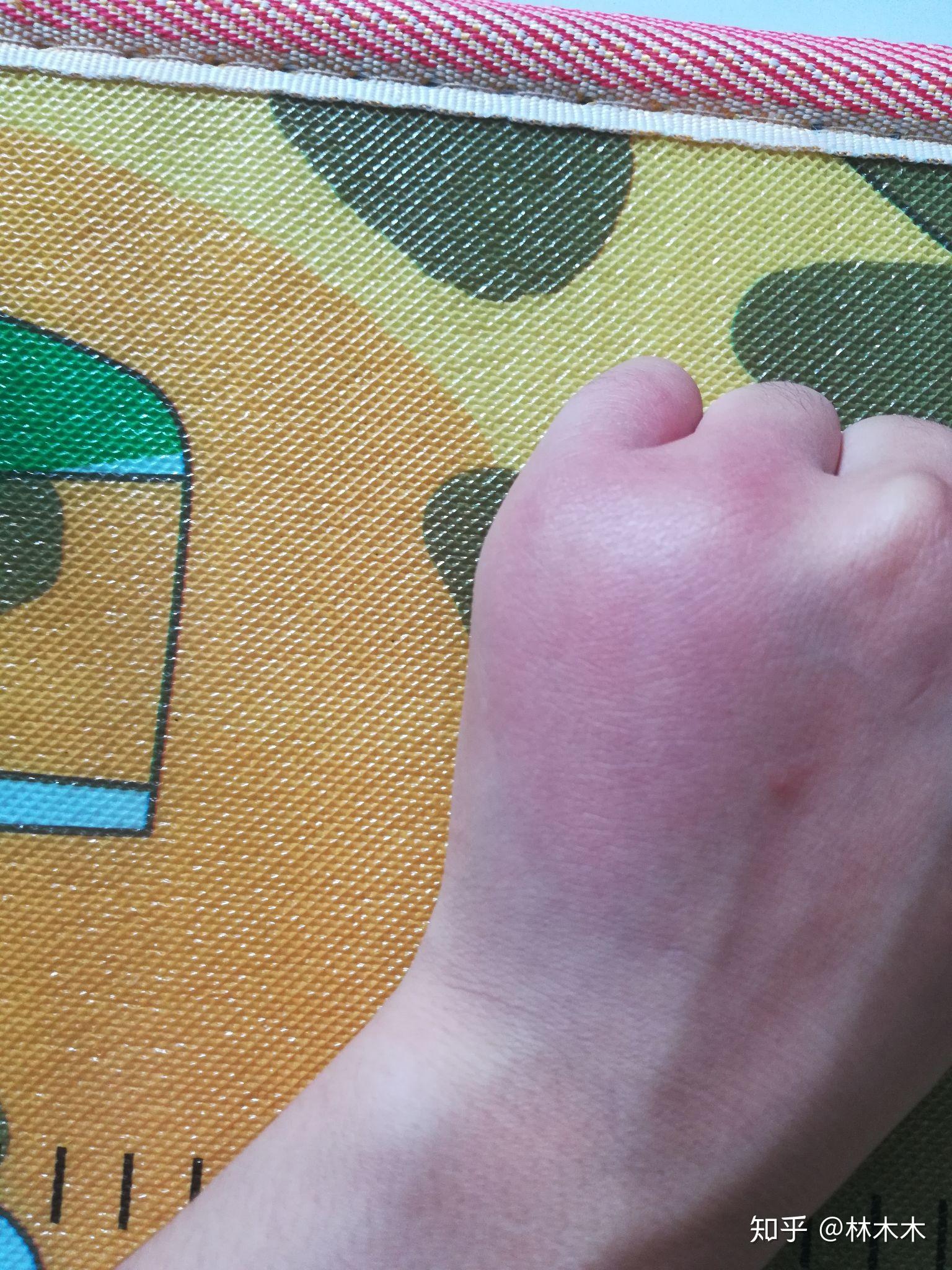 洋辣子有毒吗被蜇后怎么处理