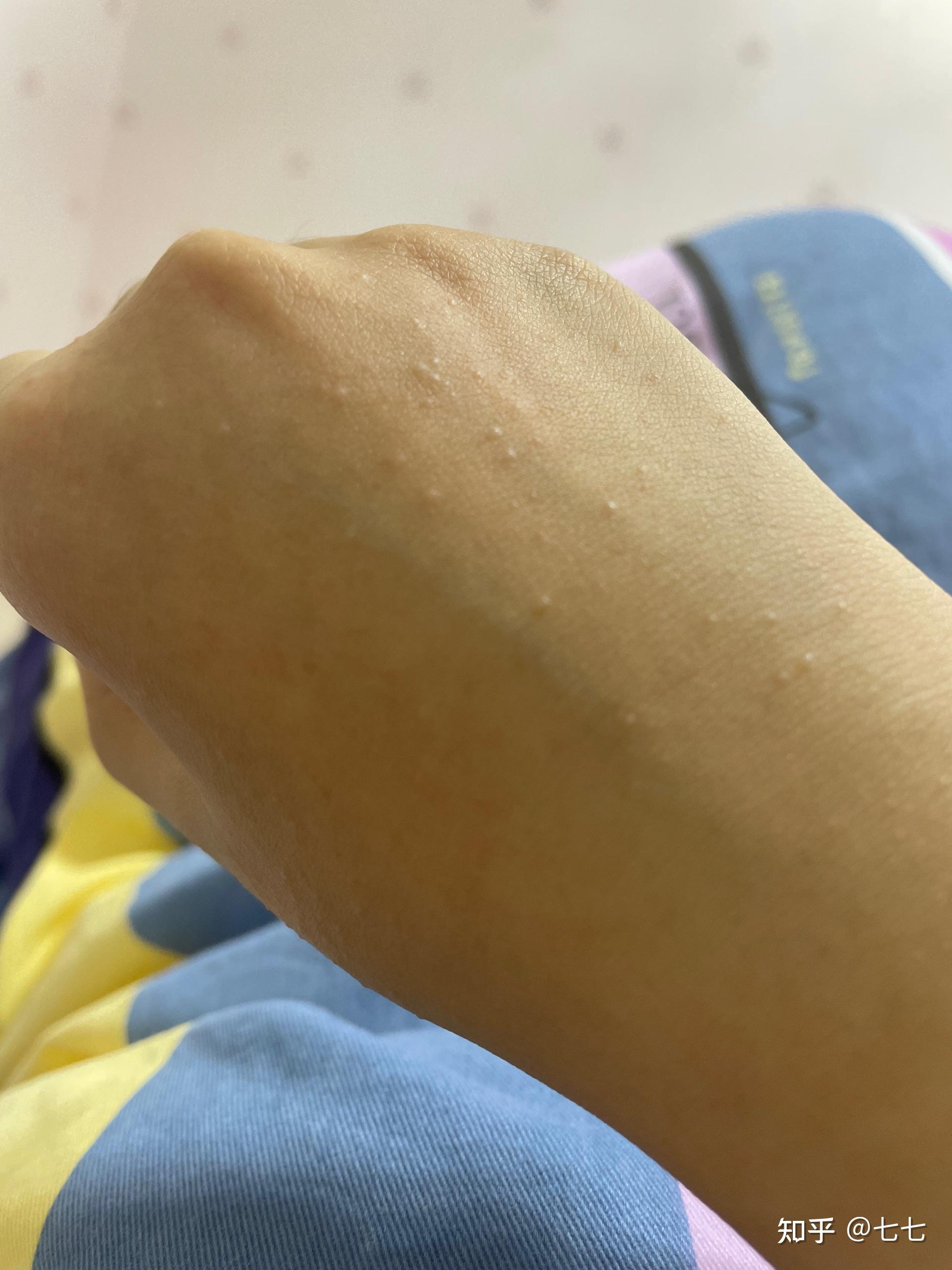 紫外线过敏/日光性皮炎 是一种怎样的感受? - 知乎