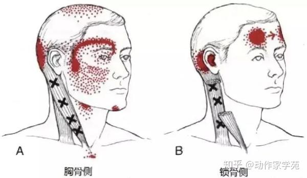 浅谈胸锁乳突肌 知乎