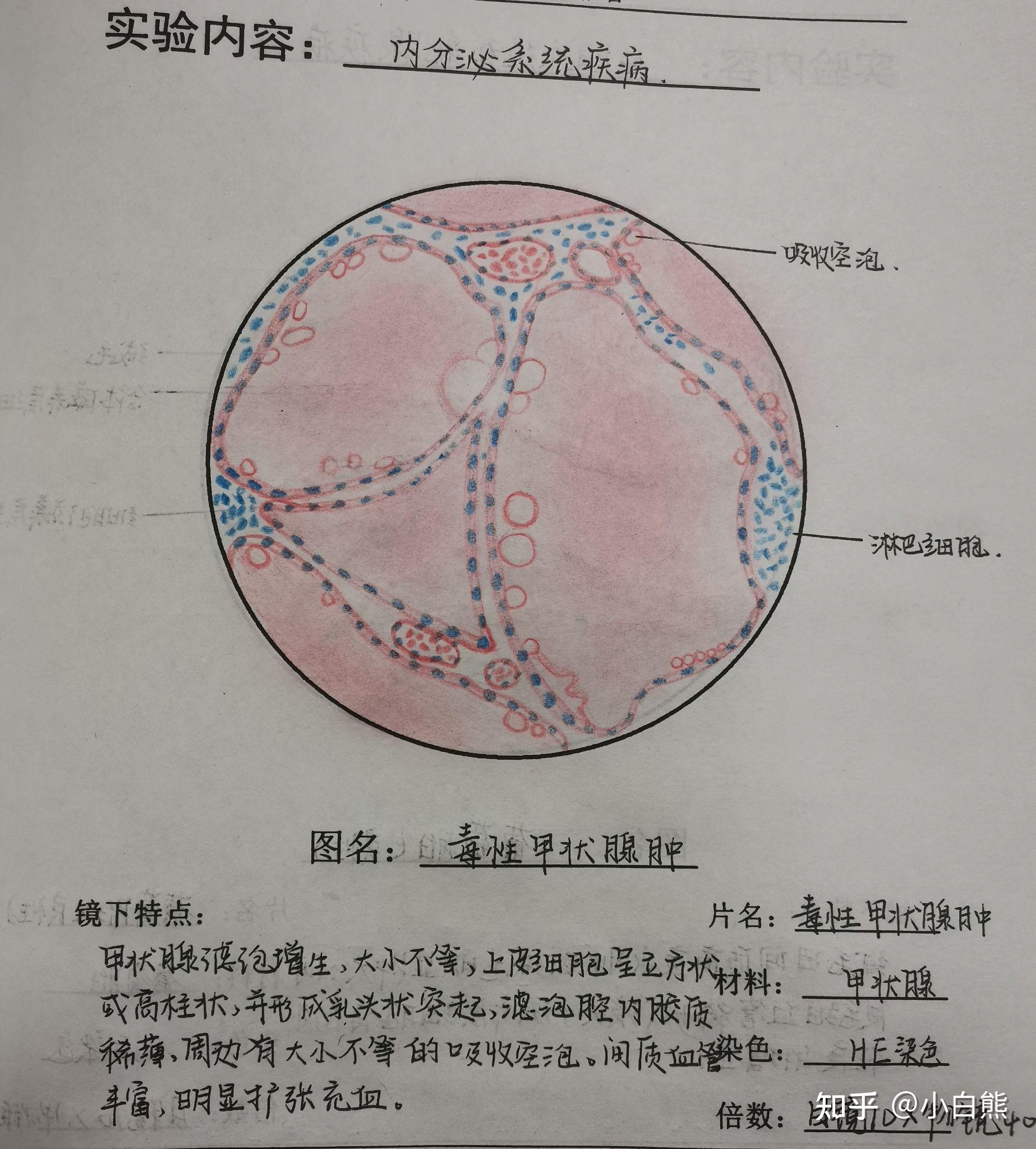 流脑红蓝铅笔图病理学图片