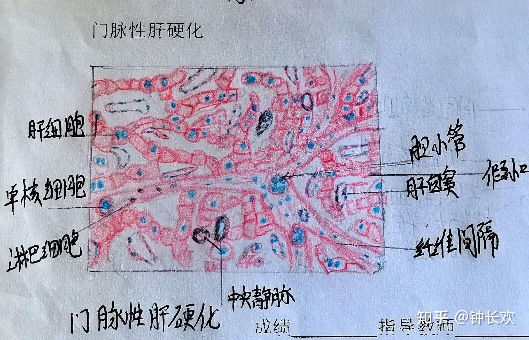 肝淤血病理切片手绘图图片