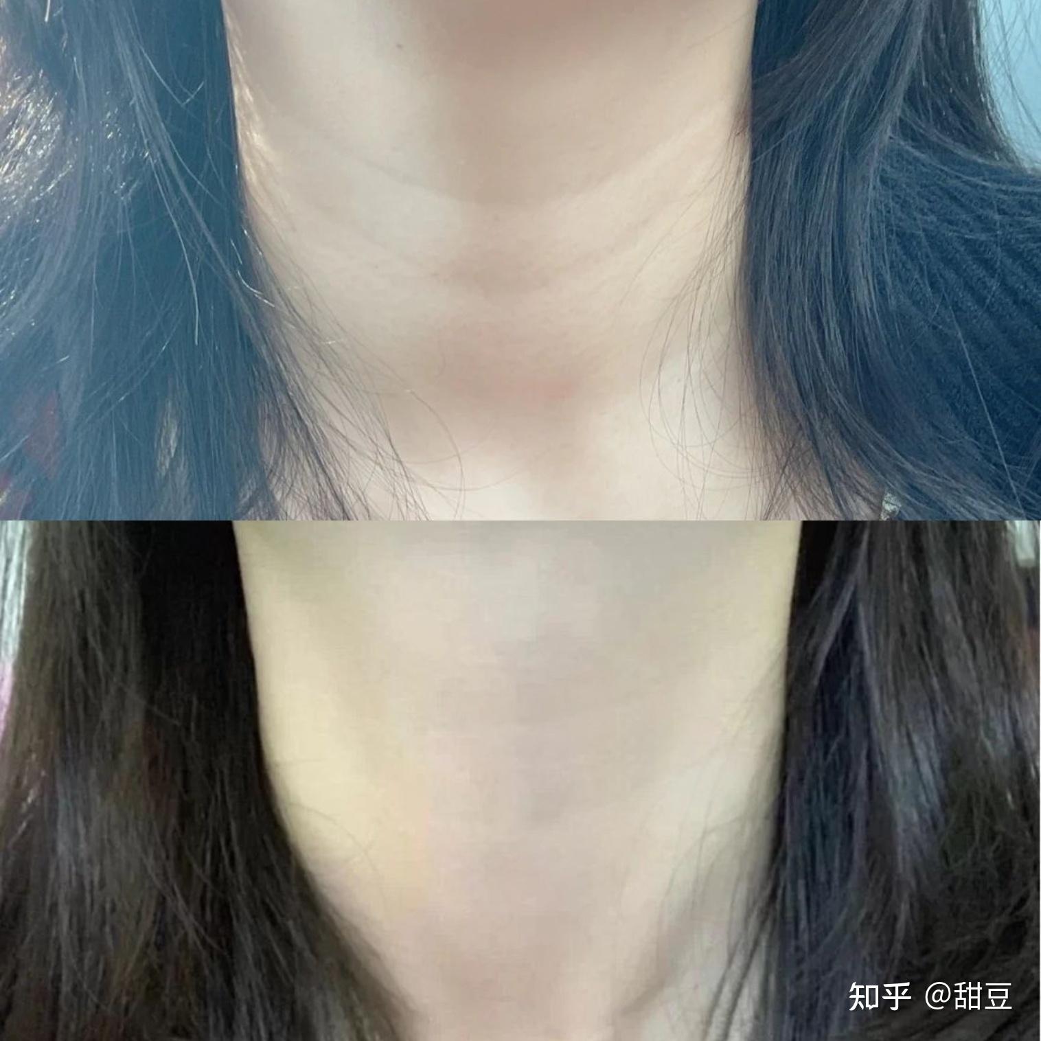如何去除脖子上的颈纹有没有什么吹爆的去颈纹方法或者产品