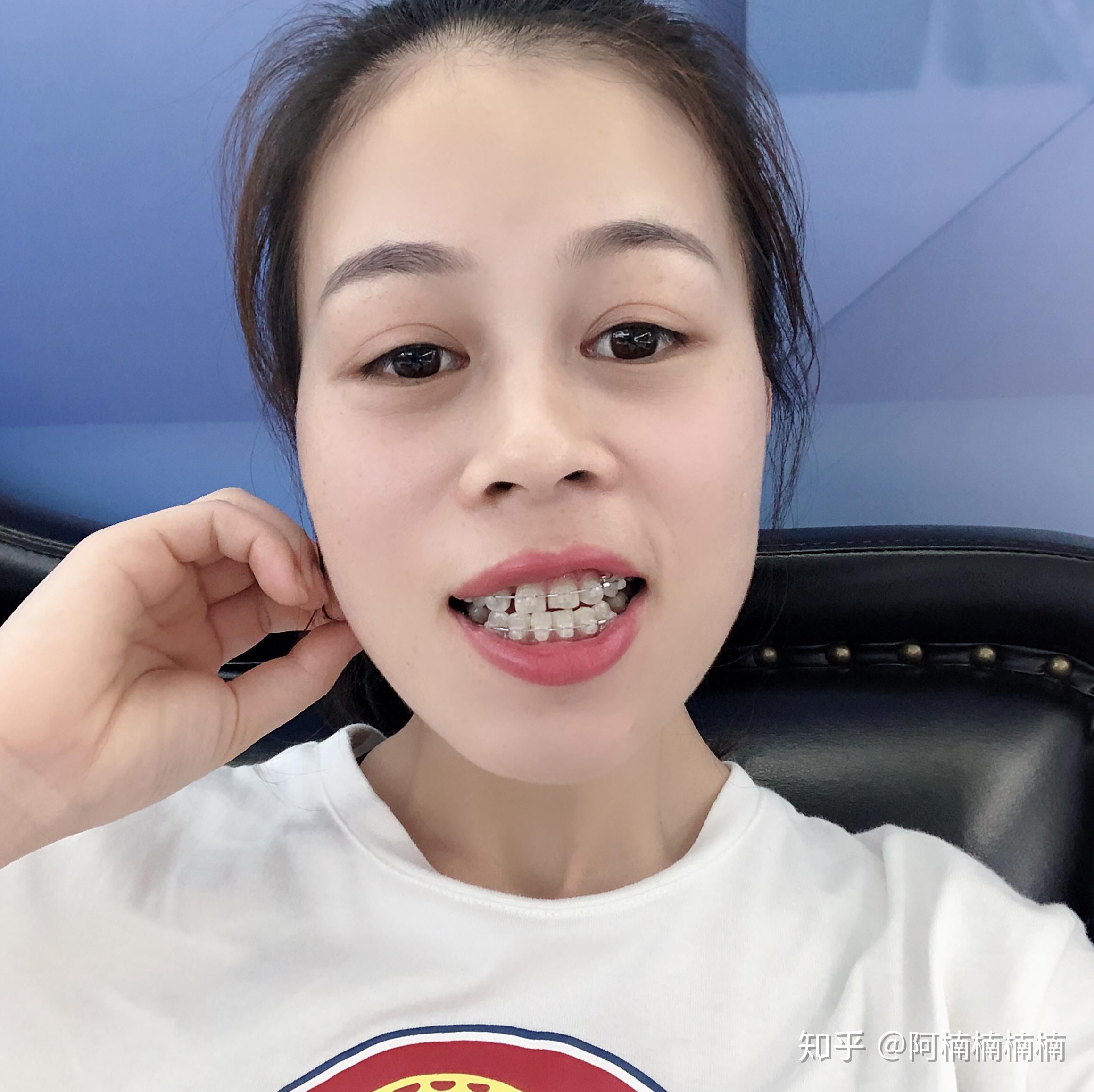 戴牙套（正畸）是什么体验？