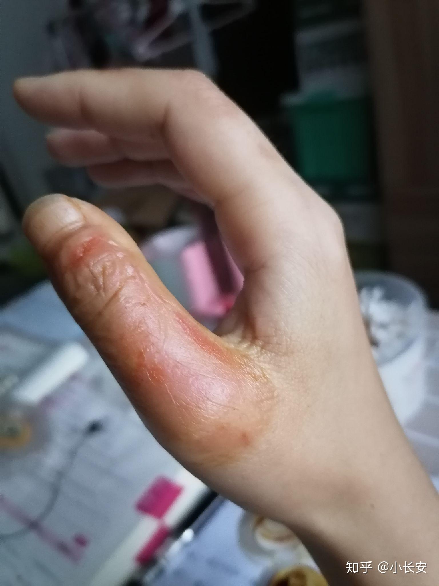 手背开水烫伤怎么恢复