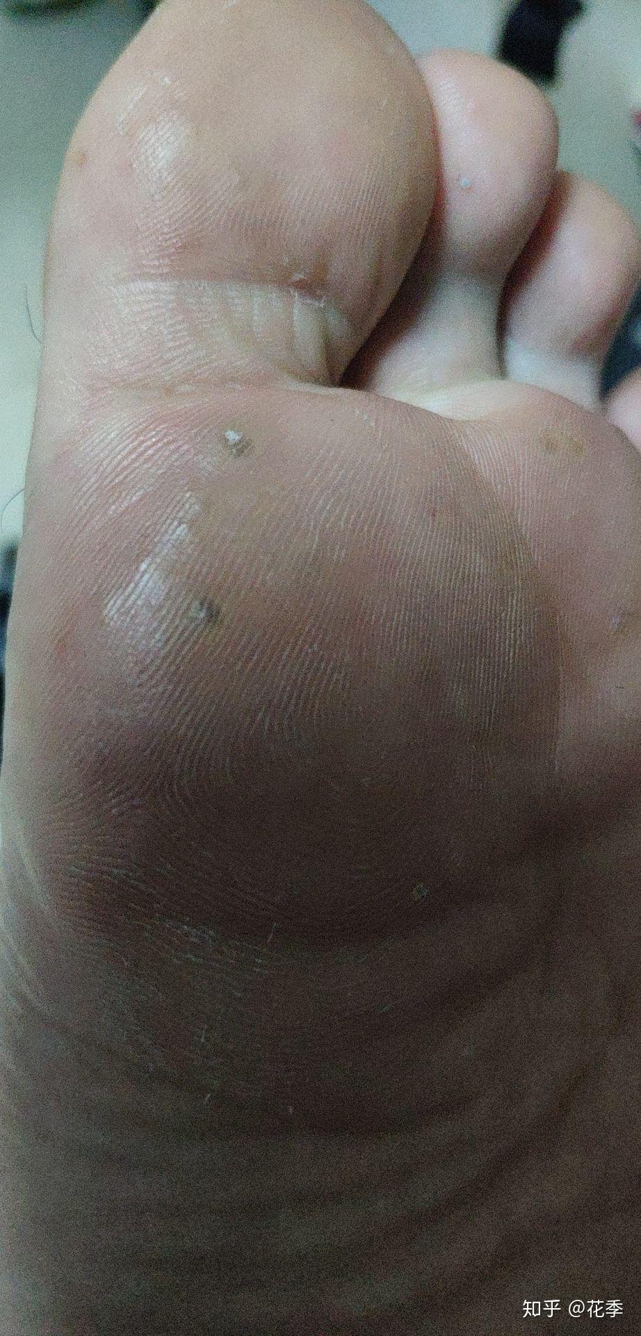 怎样治疗拓疣? - 知乎