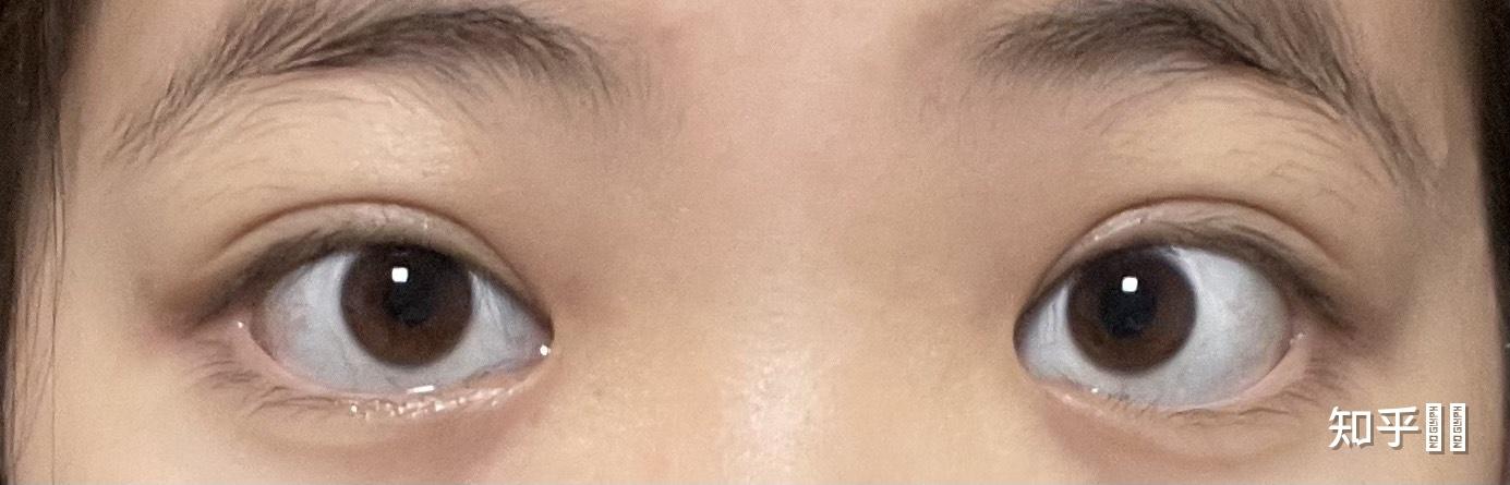 瞳孔很小,眼眶却很大,戴不戴美瞳区别很大,即将订婚了怕未来老公看到