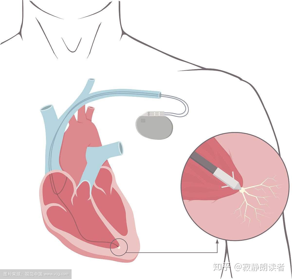 心脏最常见的这6种手术，有什么不一样，医生大白话一次讲清楚！__中国医疗