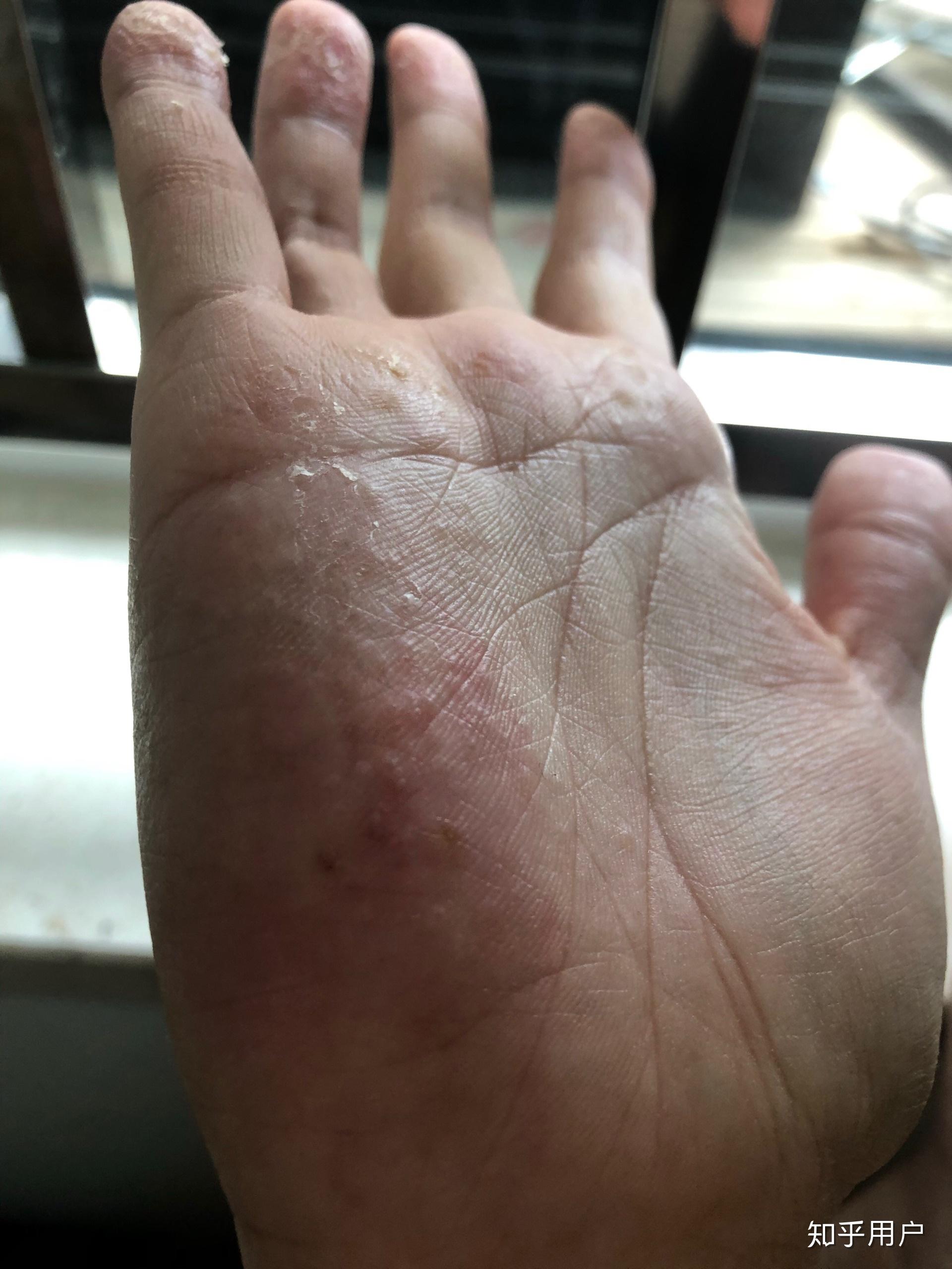 每年春天手上都会长类似水泡但比水泡小很多的泡泡微微有点痒然后会