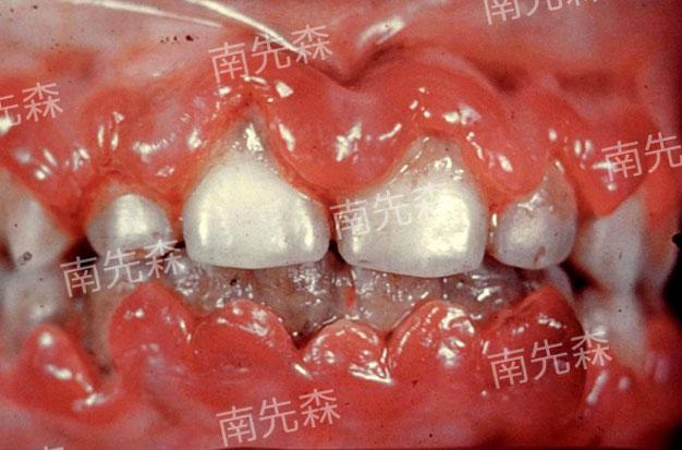 牙医碰见最烂的牙有多烂?
