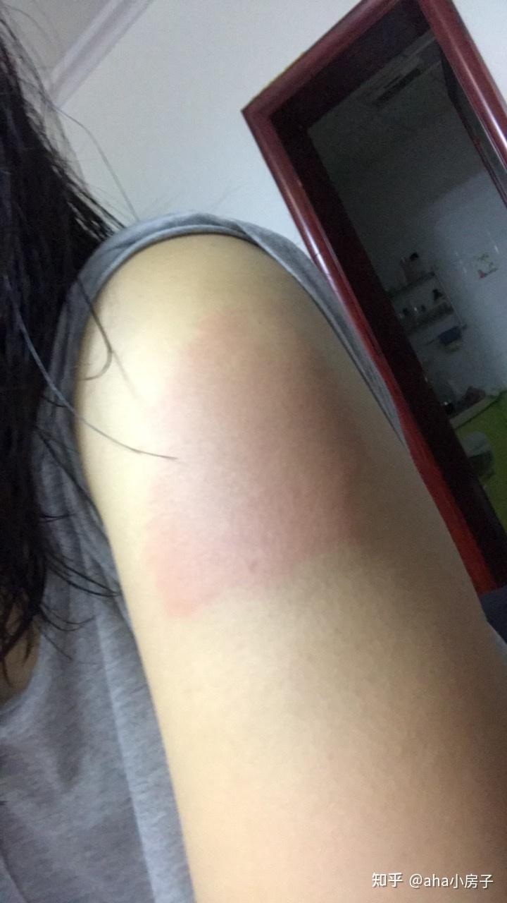 安徽智飞第二针打完过敏