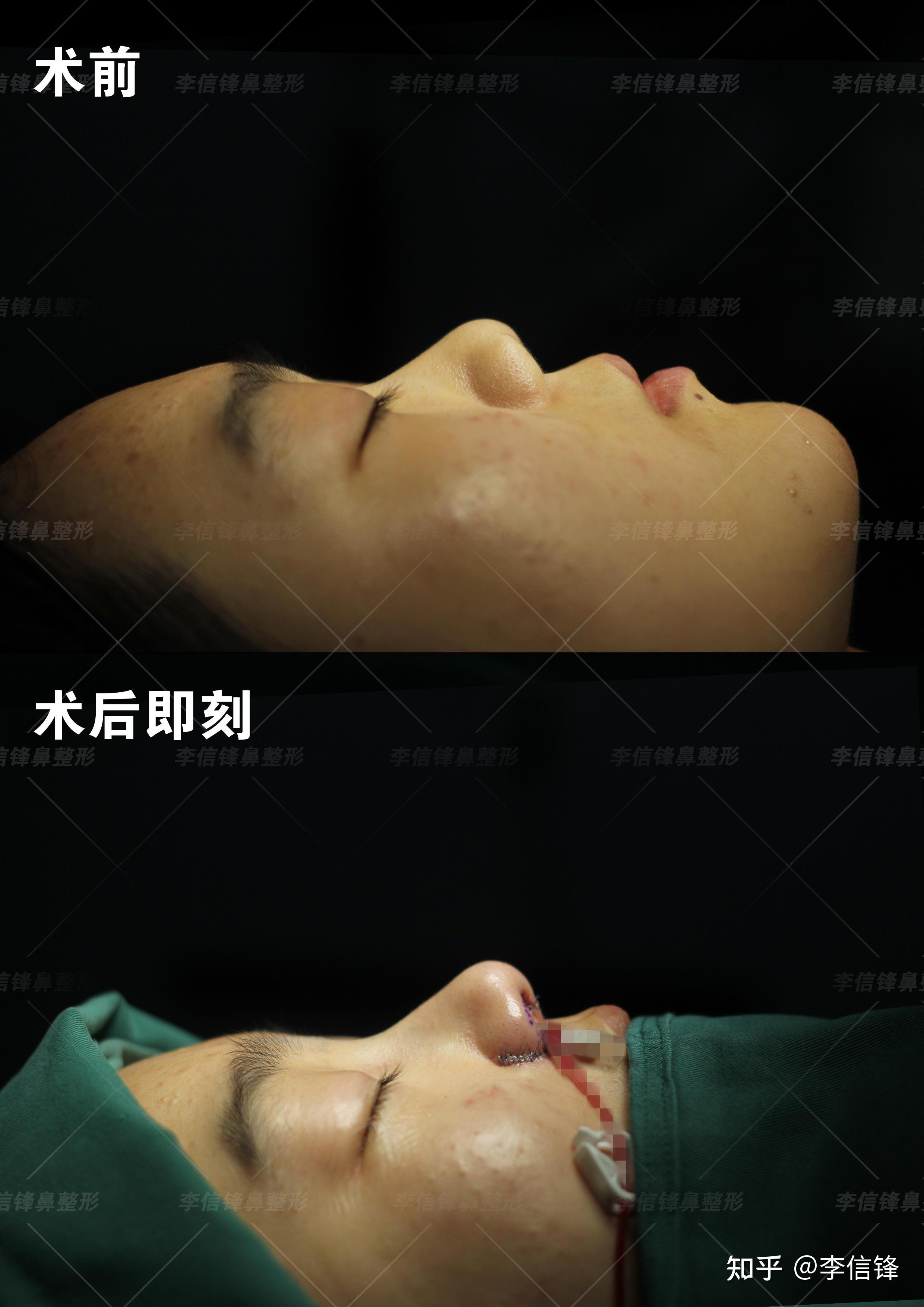 初鼻鼻综合-矮塌鼻、鼻基底凹陷改善,术后即刻对比~ - 知乎