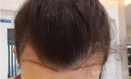 什么才算是正常发际线 v2-7e7bdbb2bac581dd17e36eb17c52eab8_r.jpg