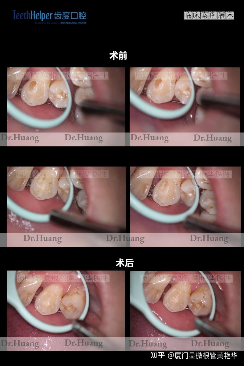 牙齿变暗出现龋洞——深龋充填一例 - 知乎