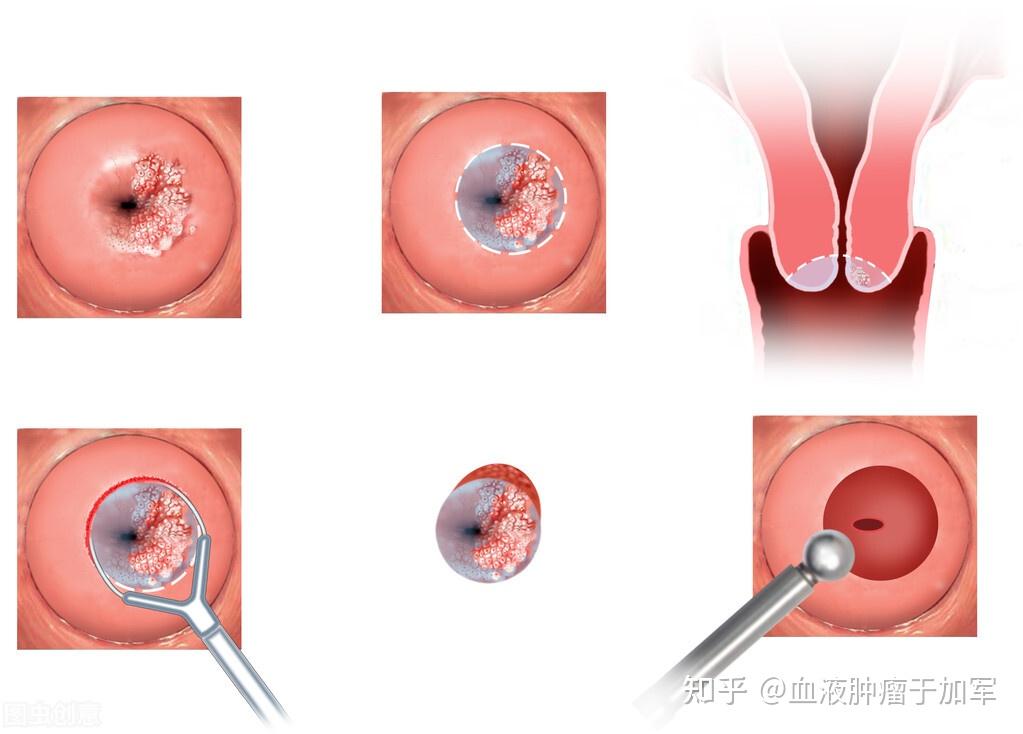 宫颈纳囊是怎么形成的图片