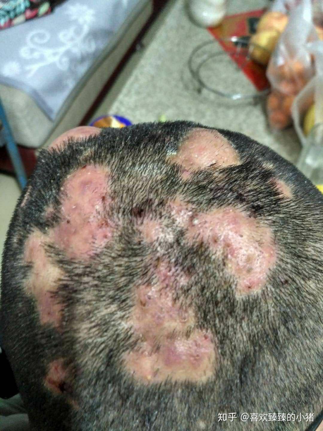 头部穿掘性毛囊炎? - 知乎