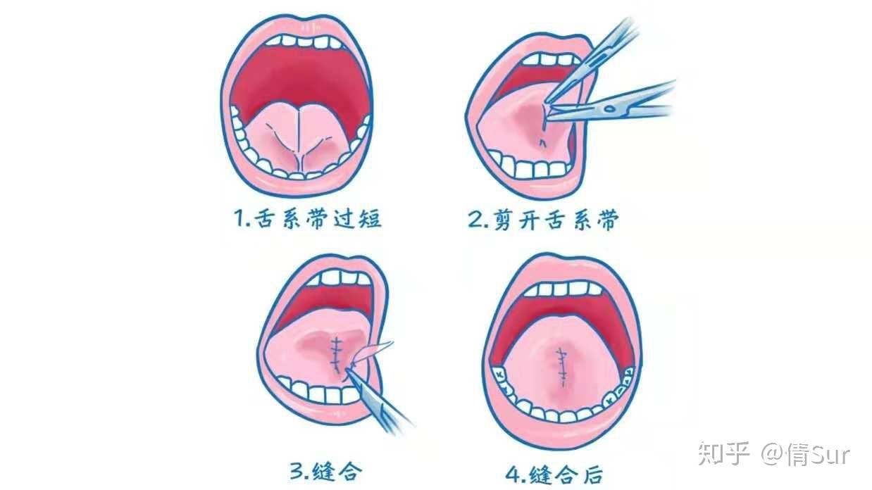 成年人舌繫帶有點影響說話剪掉好還是不剪掉好剪掉後有沒有什麼影響