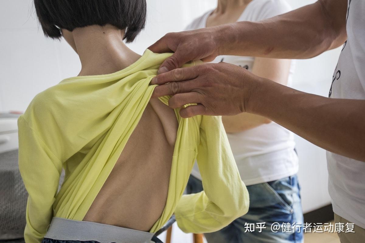 脊柱侧弯如何判断?如何治疗? - 知乎