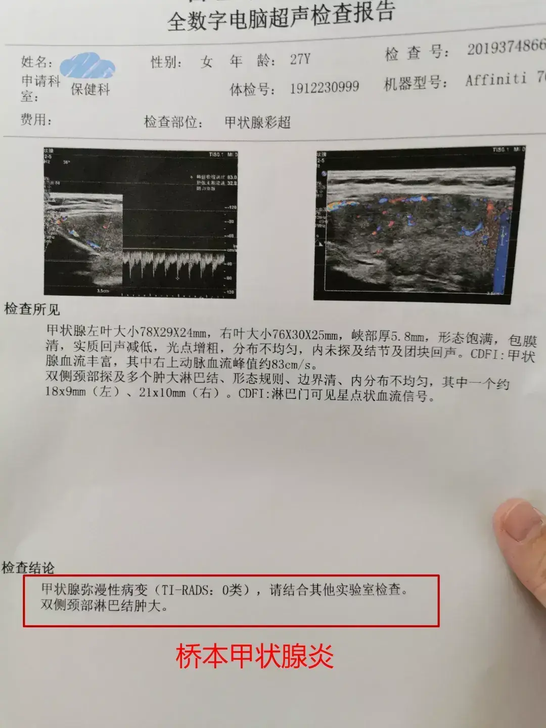 警惕这种甲状腺疾病对事业编公务员不太友好