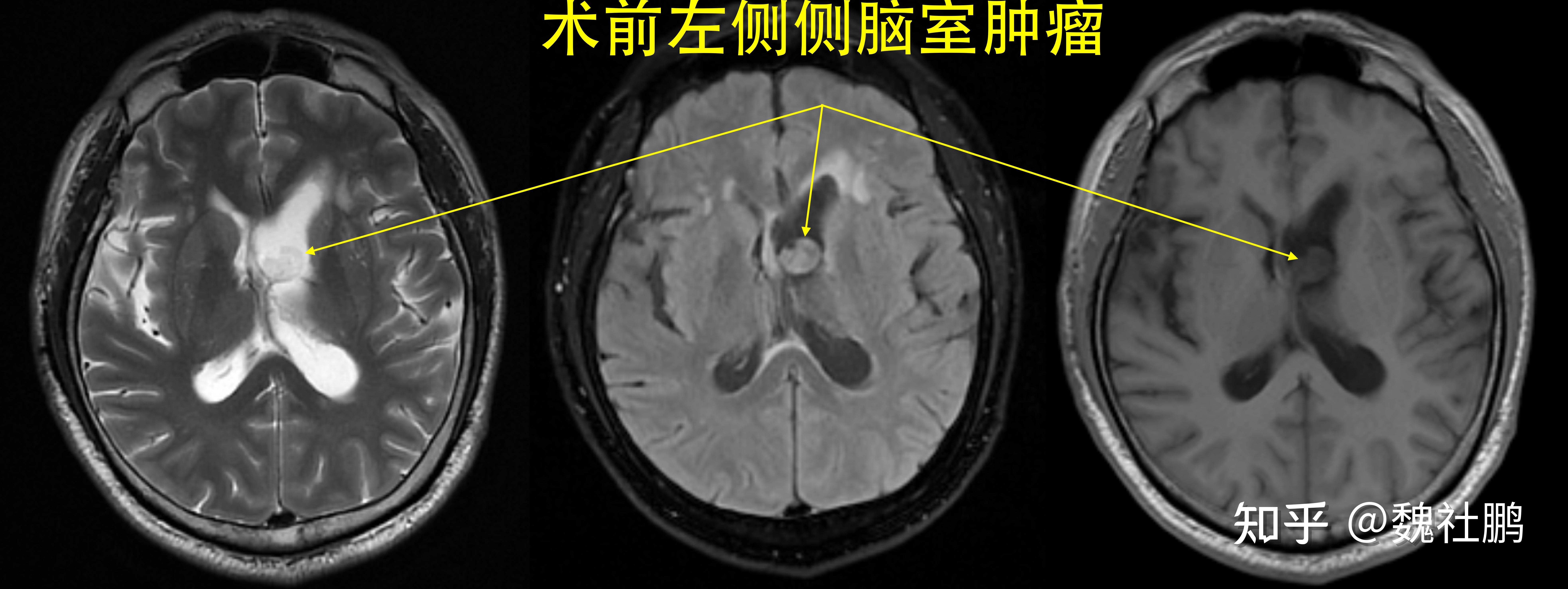 脑室增宽两侧侧脑室形态欠对称是如何造成的? - 知乎