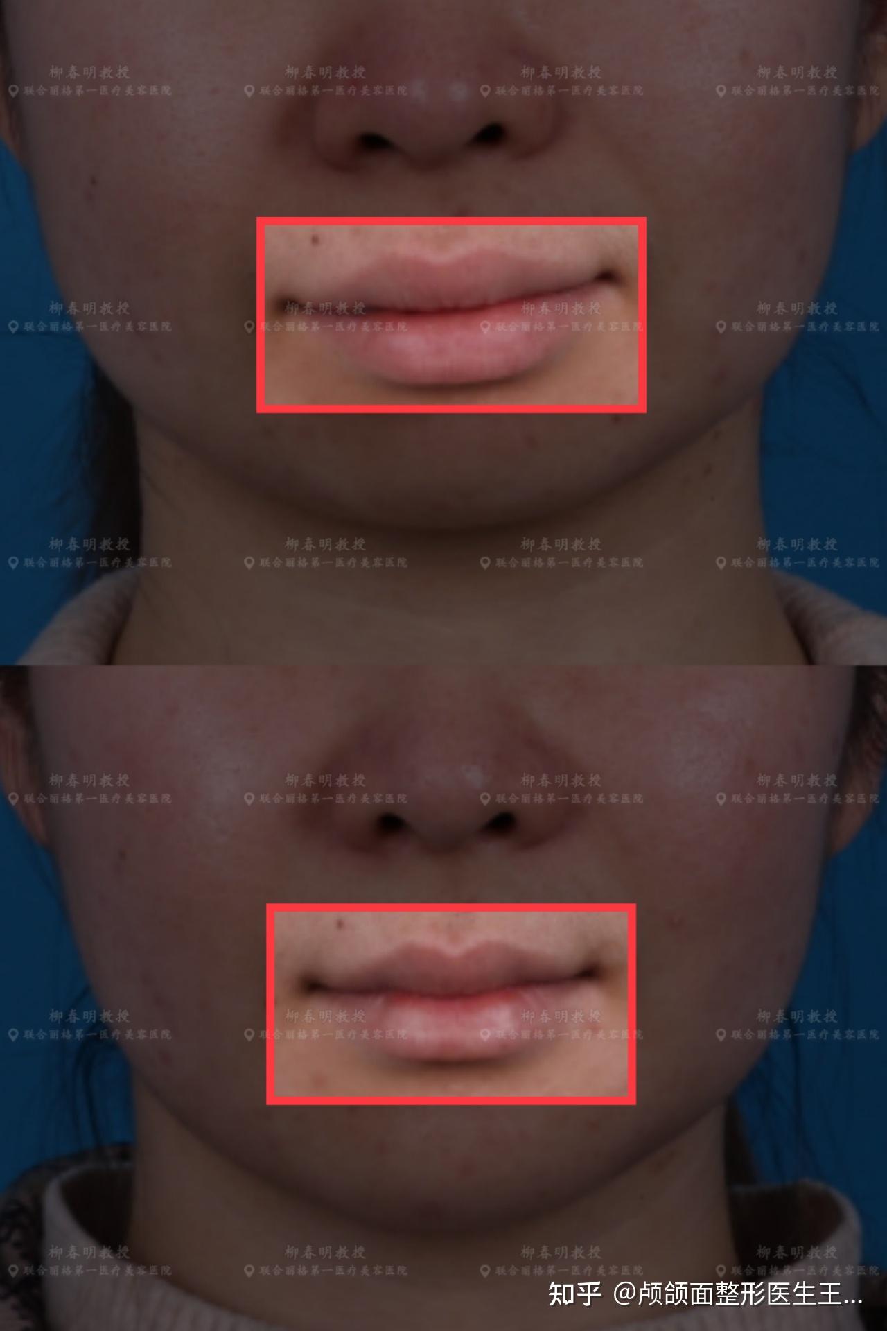 正颌手术正颌手术术后唇形的改变