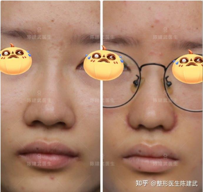 缩鼻翼后鼻孔更扁了看看这个案例