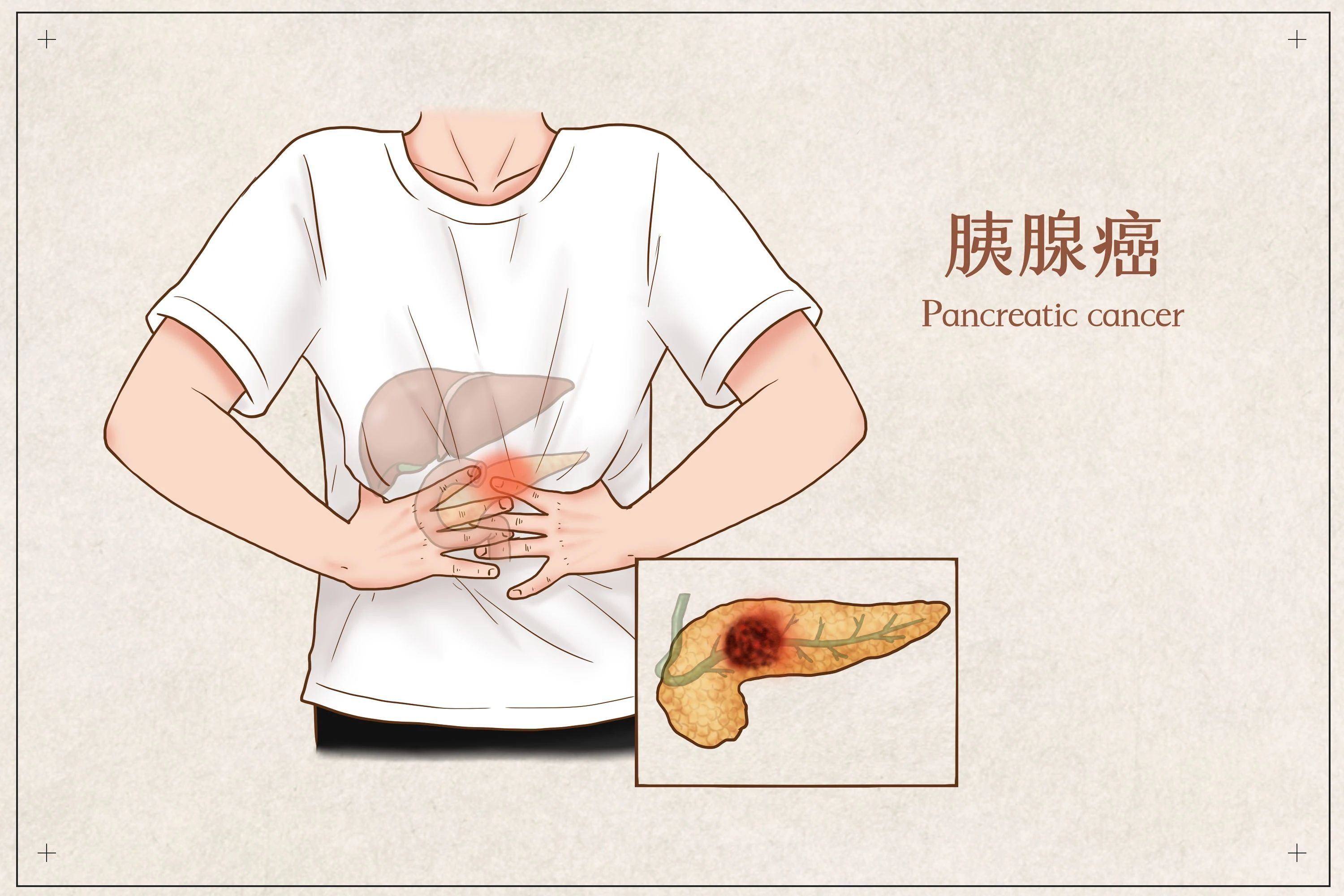胰腺手术