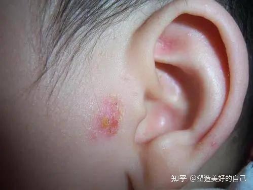 外耳湿疹怎么办？你可以这样！ - 知乎