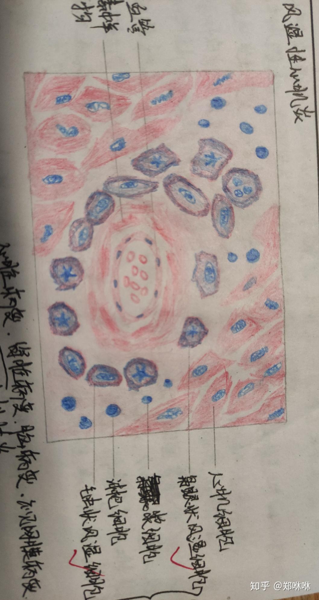胃腺癌红蓝铅笔图图片