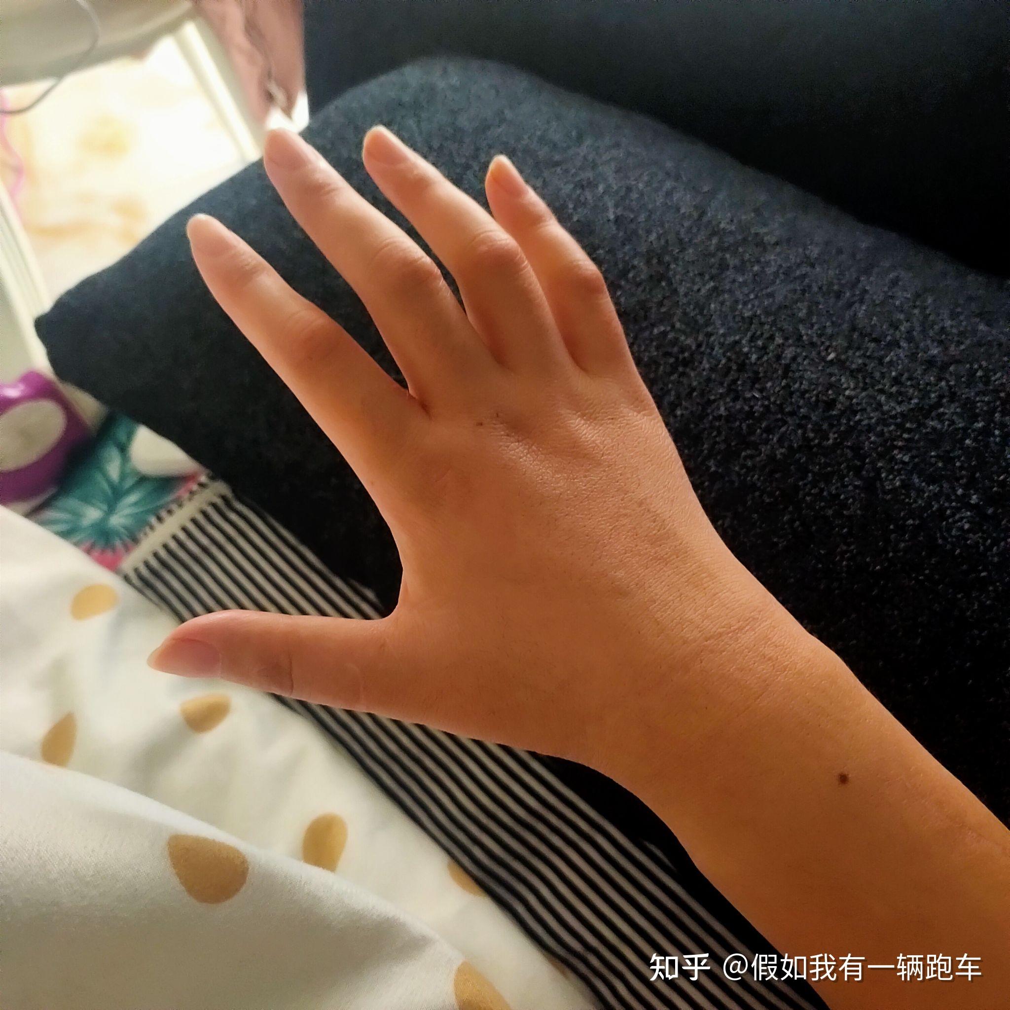 手外伤 离断16根肌腱2根主神经 血管动脉 - 知乎