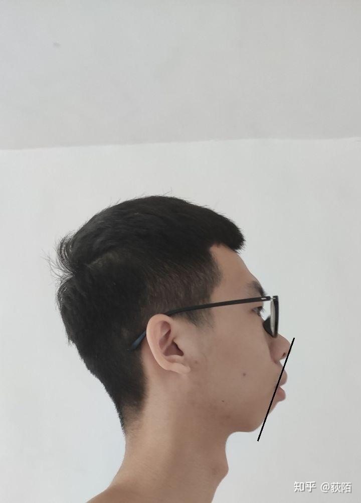我这种突嘴下巴后缩能正颌吗