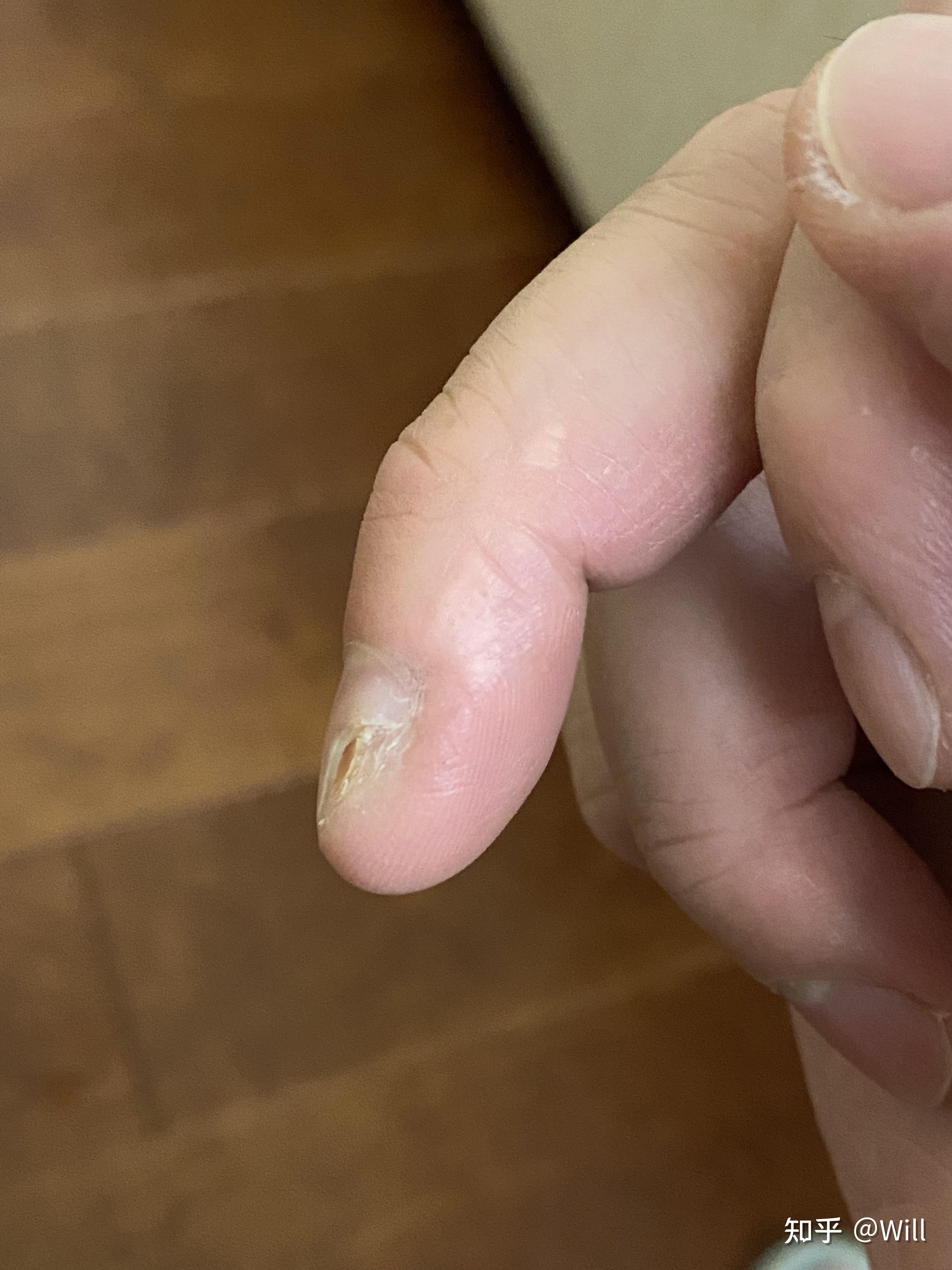 氟尿嘧啶软膏治疗甲周疣